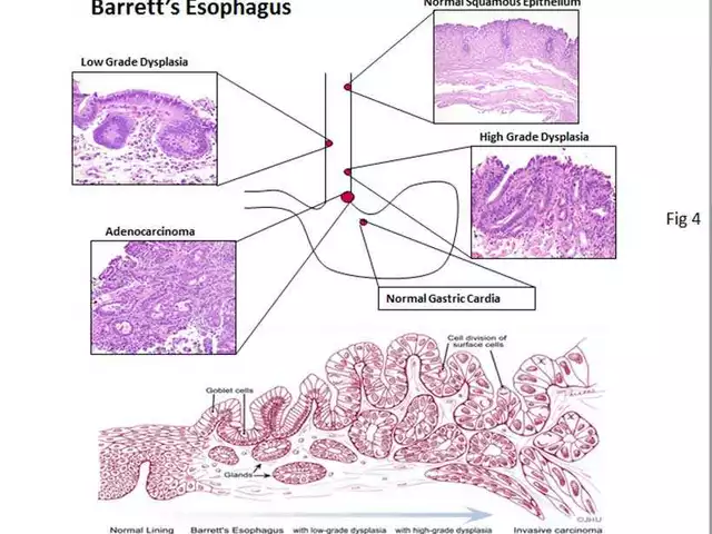 Can Dexlansoprazole Help Prevent Barrett's Esophagus?